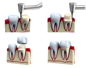 Dental Crowns Installation Process