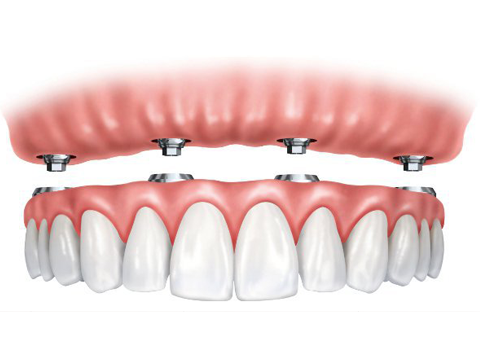implant supported denture replaces all teeth